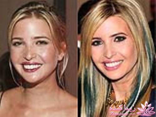 جراحی بینی - جراحی زیبایی